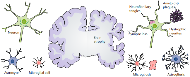 NanocellBr's tweet photo. MEDICAMENTO PARA ASMA PODE SER NOVO TRATAMENTO PARA O ALZHEIMER - https://t.co/4HoVQVBj41 https://t.co/kntNijxQfp