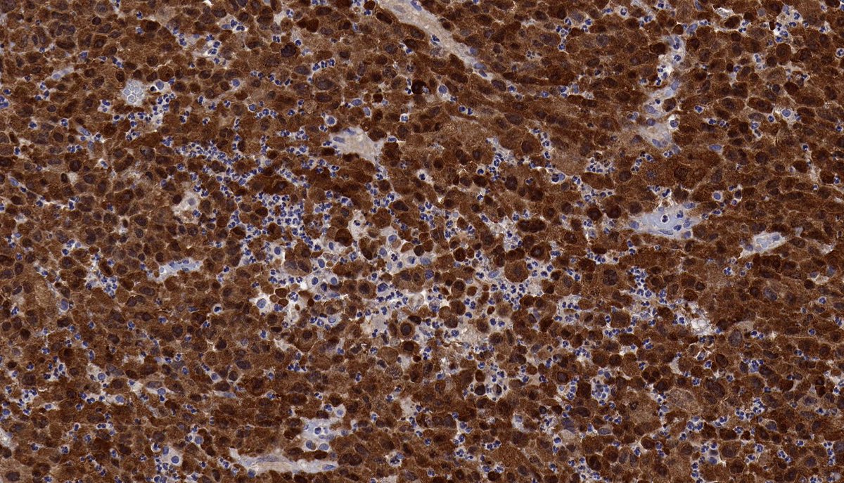 In this neoplasm IHC was diffusely positive for MDM2 and CDK4, and FISH confirmed the presence of MDM2 amplification. The findings support classification as DEDIFFERENTIATED LIPOSARCOMA (epithelioid variant). PMID: 28719466, 29307627.