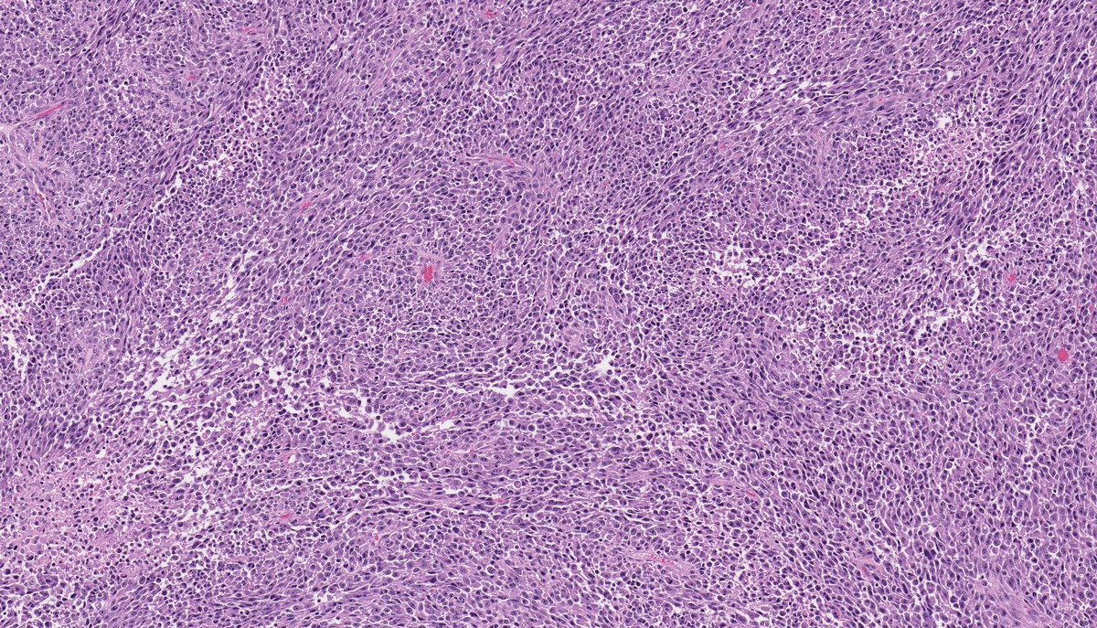 In addition to a UPS-like morphology (FISH: + MDM2 amplification), dedifferentiated liposarcoma is known for a wide range of distinctive variants, including: