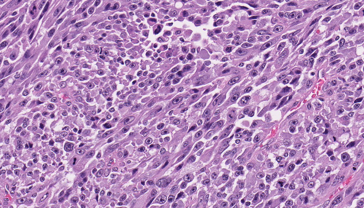 In addition to a UPS-like morphology (FISH: + MDM2 amplification), dedifferentiated liposarcoma is known for a wide range of distinctive variants, including: