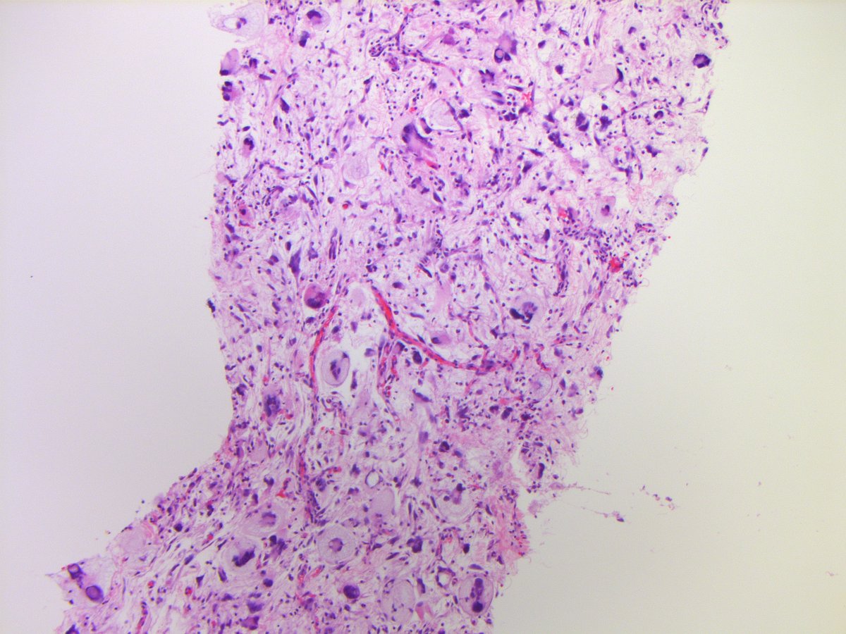 DEDIFFERENTIATED LIPOSARCOMA (myxofibrosarcoma-like variant). (FISH: + MDM2 amplification.) PMID: 10584701, 15832195, 23020289.