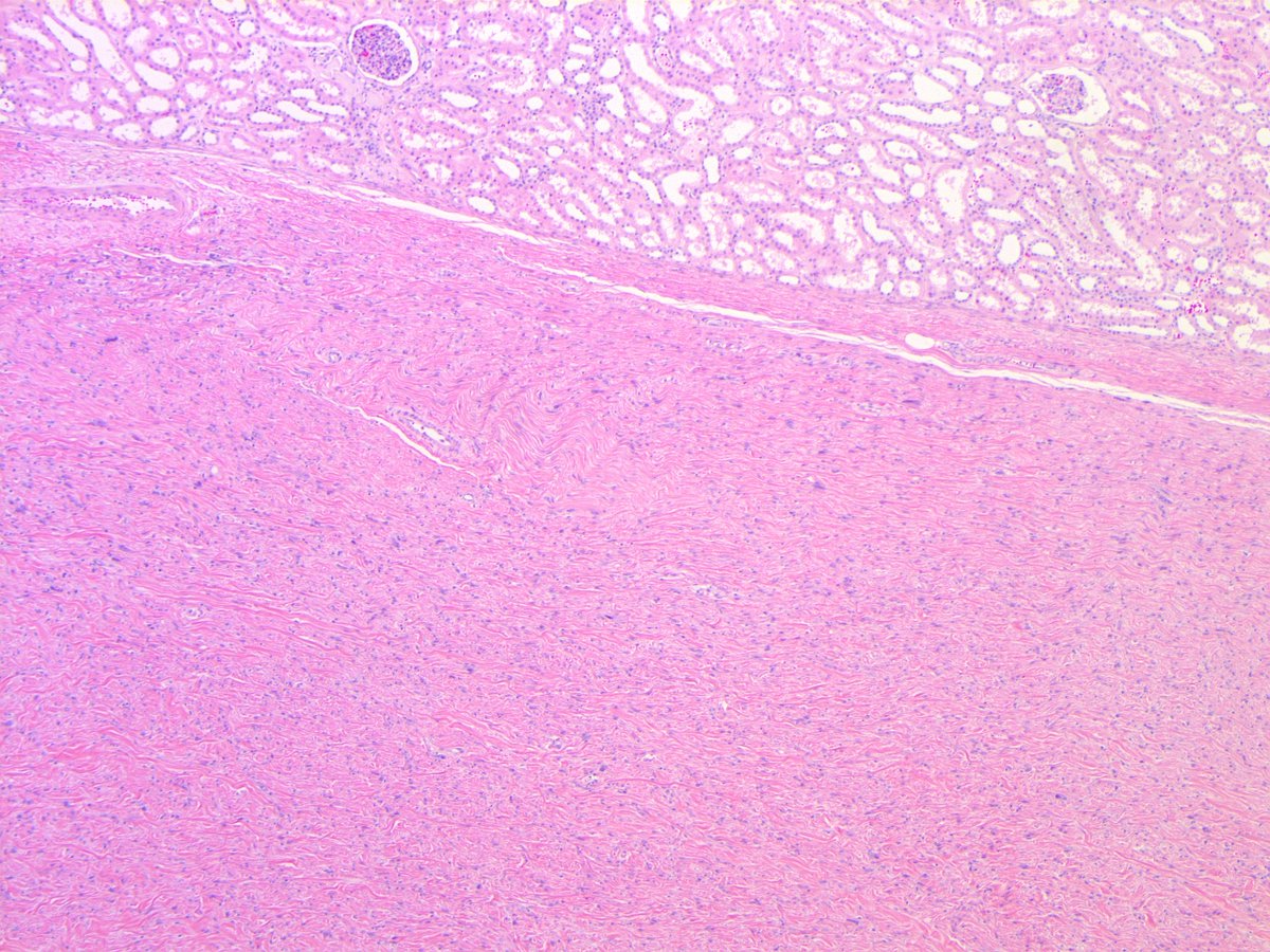 DEDIFFERENTIATED LIPOSARCOMA (with so-called 'low-grade' dedifferentiation). (FISH: + MDM2 amplification.) PMID: 9060596, 9127316.