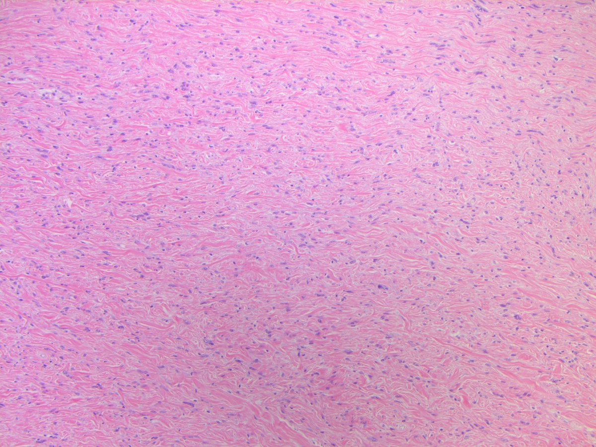 DEDIFFERENTIATED LIPOSARCOMA (with so-called 'low-grade' dedifferentiation). (FISH: + MDM2 amplification.) PMID: 9060596, 9127316.