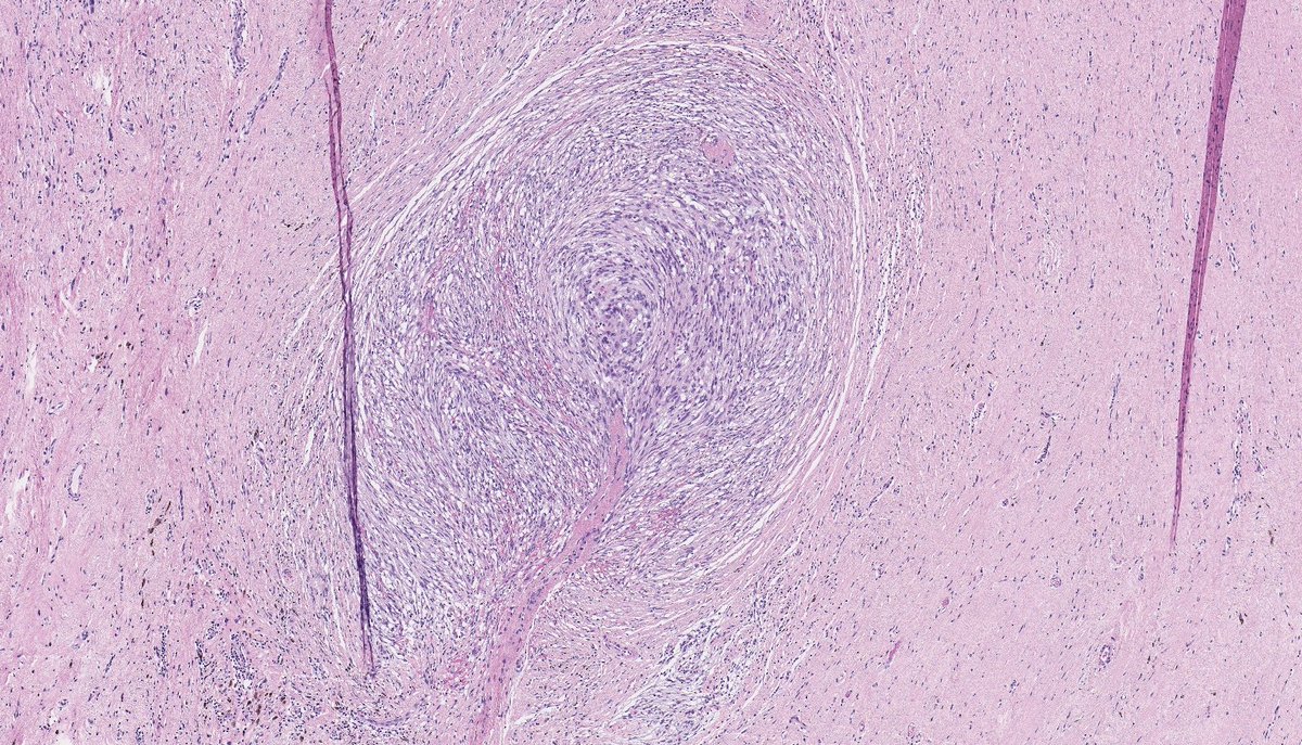DEDIFFERENTIATED LIPOSARCOMA (with meningothelial-like whorls and metaplastic bone formation). (FISH: + MDM2 amplification.) PMID: 9839165, 21317707.