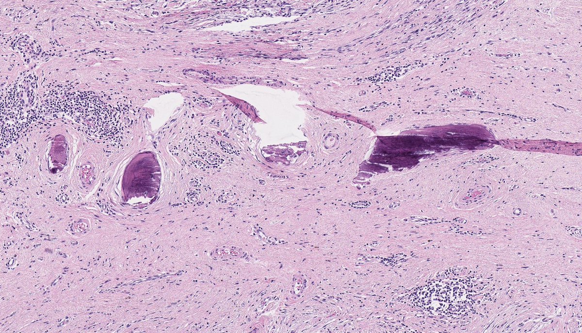 DEDIFFERENTIATED LIPOSARCOMA (with meningothelial-like whorls and metaplastic bone formation). (FISH: + MDM2 amplification.) PMID: 9839165, 21317707.