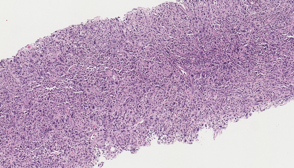 DEDIFFERENTIATED LIPOSARCOMA (with inflammation, incl. leukemoid reaction). (FISH: + MDM2 amplification.) PMID: 9311018, 11391379.