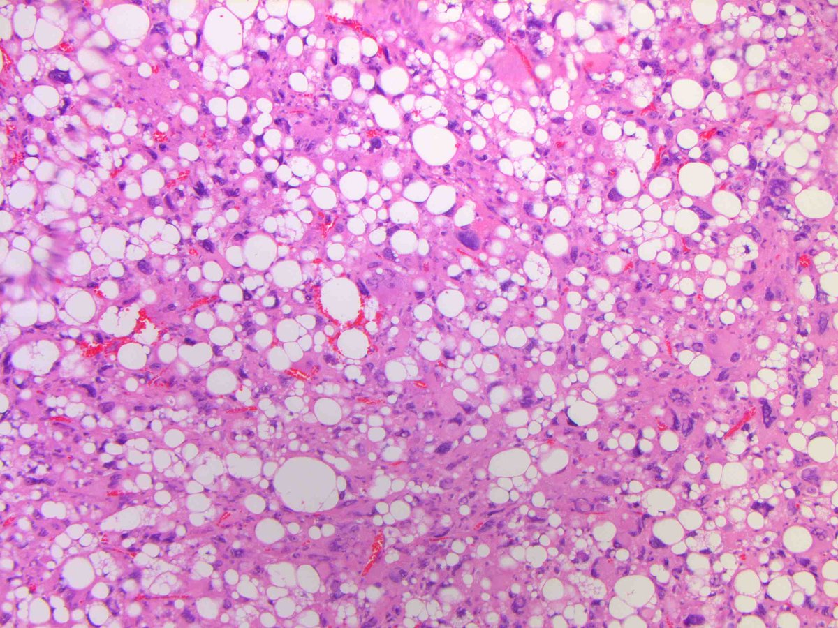 DEDIFFERENTIATED LIPOSARCOMA (with "homologous" lipoblastic [pleomorphic liposarcoma-like] differentiation). (FISH: + MDM2 amplification.) PMID: 20588177.