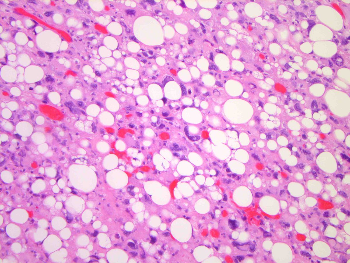 DEDIFFERENTIATED LIPOSARCOMA (with "homologous" lipoblastic [pleomorphic liposarcoma-like] differentiation). (FISH: + MDM2 amplification.) PMID: 20588177.