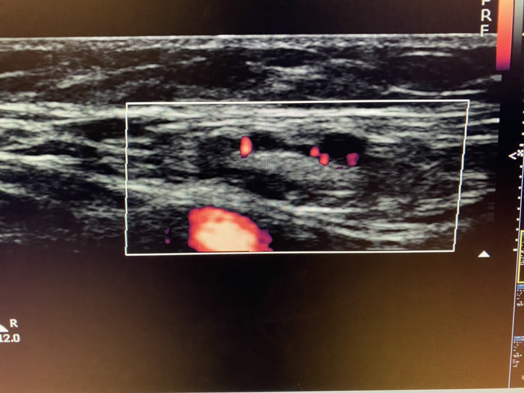sono_sam's tweet photo. Just a nice example of a lymph node.
✅ Relatively superficial
✅Ovoid
✅Fatty (hyperechoic) hilum
✅Hypoechoic cortex
✅Some vascularity
✅SFA to drive home spatial relationship
#POCUS #IMPOCUS #FOAMed #FOAMus #picofapic #sorrynotsorry #sonotips #sonography https://t.co/15QCDclTa2