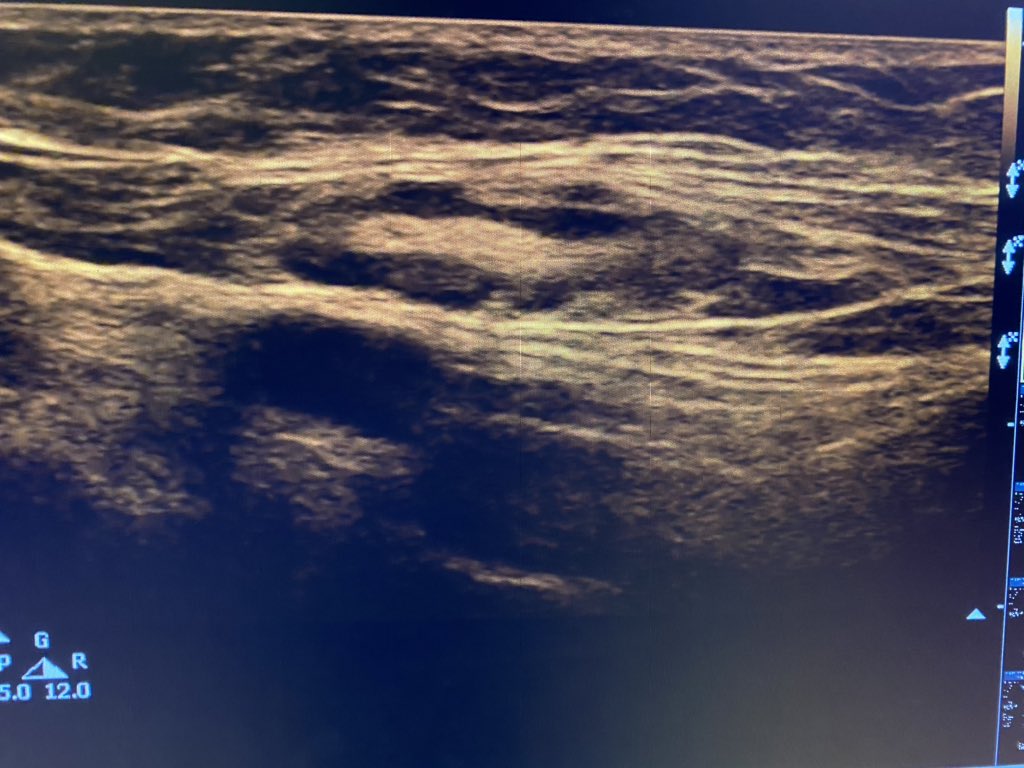 sono_sam's tweet photo. Just a nice example of a lymph node.
✅ Relatively superficial
✅Ovoid
✅Fatty (hyperechoic) hilum
✅Hypoechoic cortex
✅Some vascularity
✅SFA to drive home spatial relationship
#POCUS #IMPOCUS #FOAMed #FOAMus #picofapic #sorrynotsorry #sonotips #sonography https://t.co/15QCDclTa2