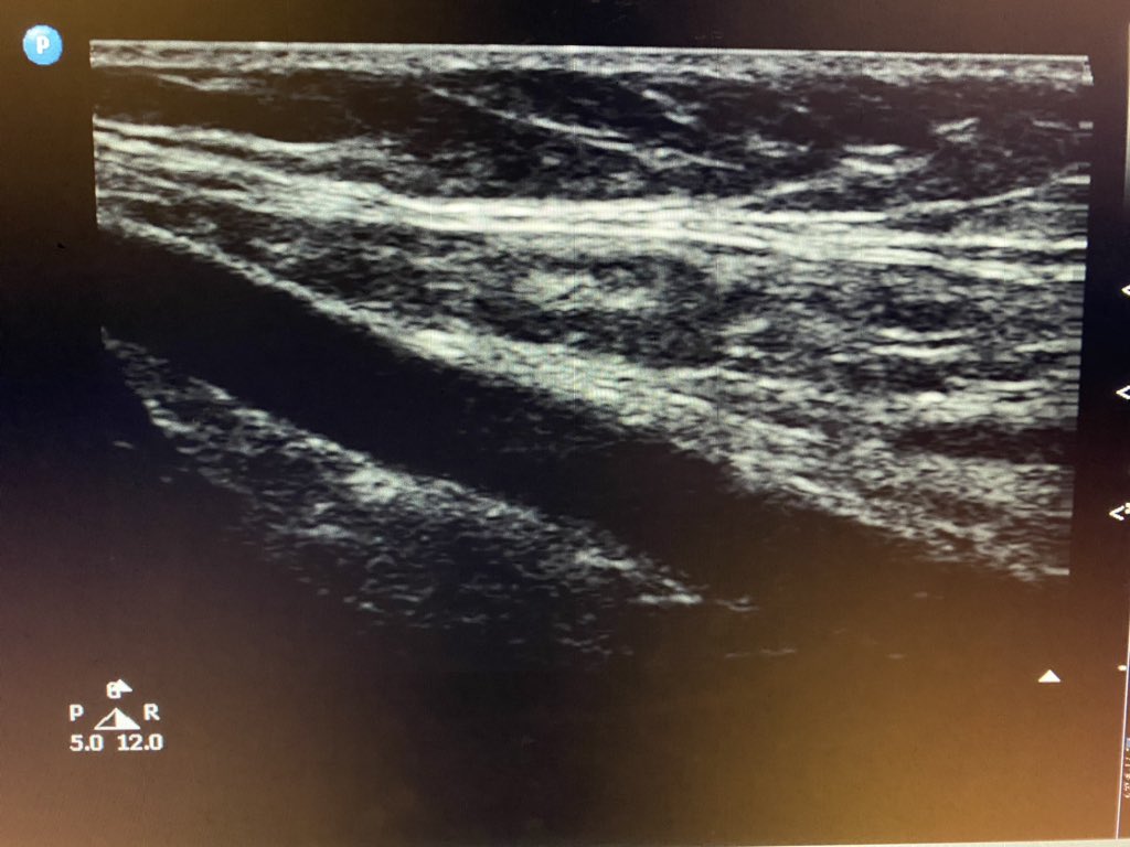 sono_sam's tweet photo. Just a nice example of a lymph node.
✅ Relatively superficial
✅Ovoid
✅Fatty (hyperechoic) hilum
✅Hypoechoic cortex
✅Some vascularity
✅SFA to drive home spatial relationship
#POCUS #IMPOCUS #FOAMed #FOAMus #picofapic #sorrynotsorry #sonotips #sonography https://t.co/15QCDclTa2