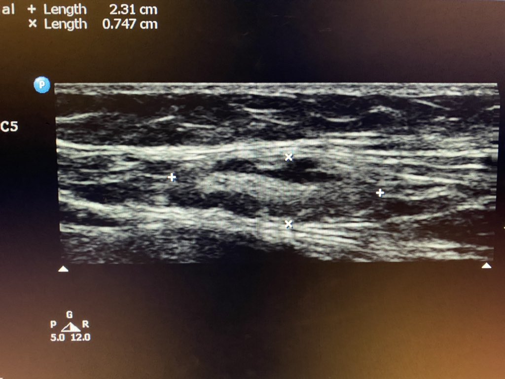 sono_sam's tweet photo. Just a nice example of a lymph node.
✅ Relatively superficial
✅Ovoid
✅Fatty (hyperechoic) hilum
✅Hypoechoic cortex
✅Some vascularity
✅SFA to drive home spatial relationship
#POCUS #IMPOCUS #FOAMed #FOAMus #picofapic #sorrynotsorry #sonotips #sonography https://t.co/15QCDclTa2