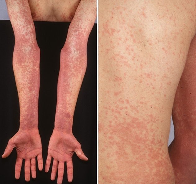 elcasodeldia's tweet photo. Paciente de 15 años consulta por dolor de garganta, fiebre y rash. 
Presenta placas blanquecinas en las amígdalas. 
CUÁL ES EL DIAGNÓSTICO? #casodeldia https://t.co/rTvd1QPxEa