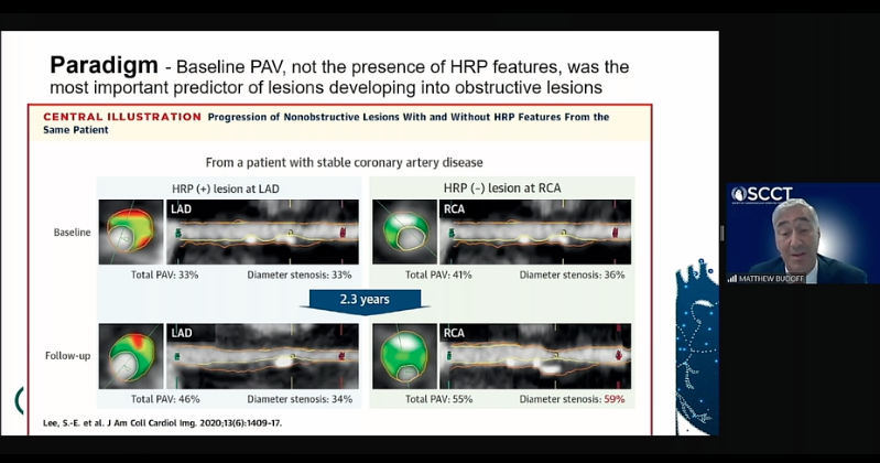 DAICeditor's tweet photo. A review of some of the top new cardiac CT trials by Matt Budoff, M.D., at #SCCT2020 today. Overview of the PARADIGM, EVAPORATE, ADVANCE, FORECAST, PRECISE, CTP-PRO, and WARRIOR trials.
https://t.co/UnSh9rtoj0
#SCCT2020 #CCTAfirst #Radiology #CVimaging #CT #cardiotwitter https://t.co/rfFL7LQSO5