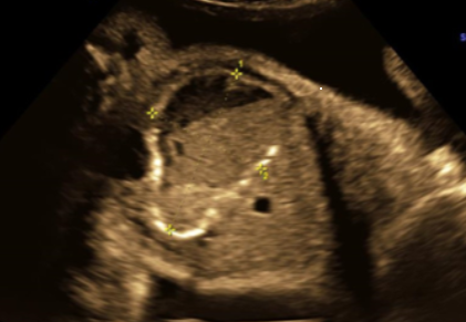 ISUOG's tweet image. #ISUOG Education quiz!

Which is the most like diagnosis related to this fluid-filled cyst with thickened wall? bit.ly/3fF77th

1.       Ovarian cyst
2.       Meconium pseudocyst
3.       Mesenteric cyst
4.       Ileal obstruction
5.       Hydrometrocolpus