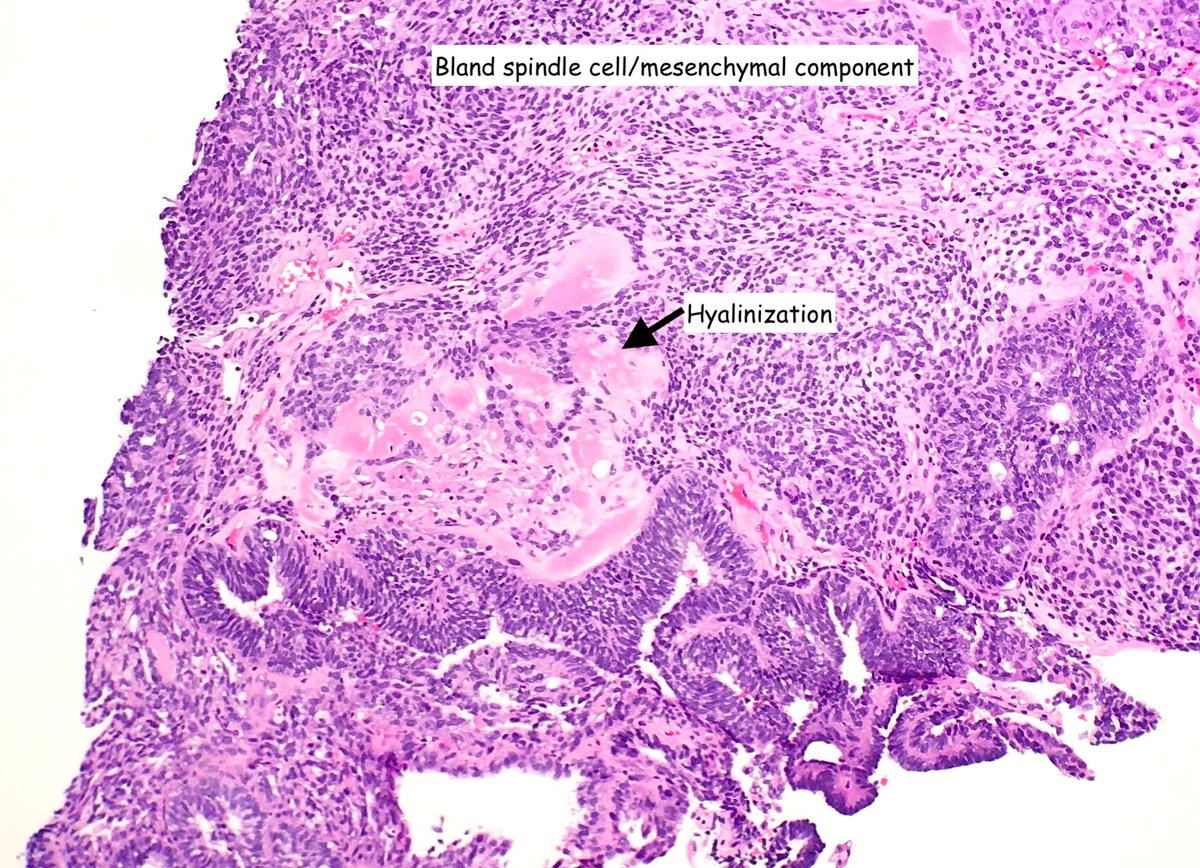 Mvgs1706's tweet photo. Corded and hyalinized endometrioid carcinoma (CHEC) can have osseous metaplasia..
not to be mistaken for heterologous elements of MMMT!

Clues:
- low grade endometrioid comp
- bland spindle cell component
- hyalinization
- p53 can help (wild type)
#Gynpath https://t.co/BSczDPer0G