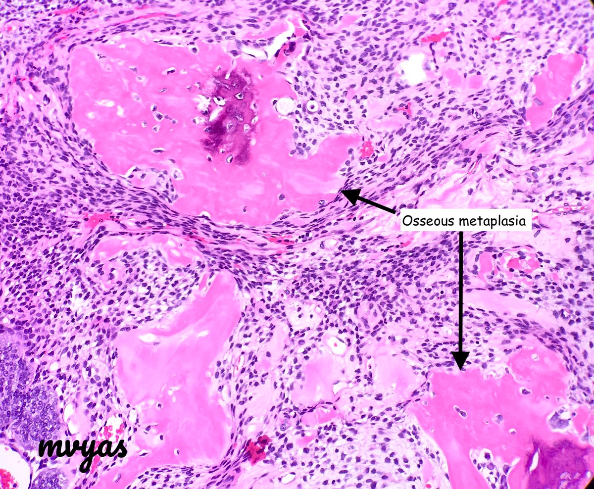 Mvgs1706's tweet photo. Corded and hyalinized endometrioid carcinoma (CHEC) can have osseous metaplasia..
not to be mistaken for heterologous elements of MMMT!

Clues:
- low grade endometrioid comp
- bland spindle cell component
- hyalinization
- p53 can help (wild type)
#Gynpath https://t.co/BSczDPer0G