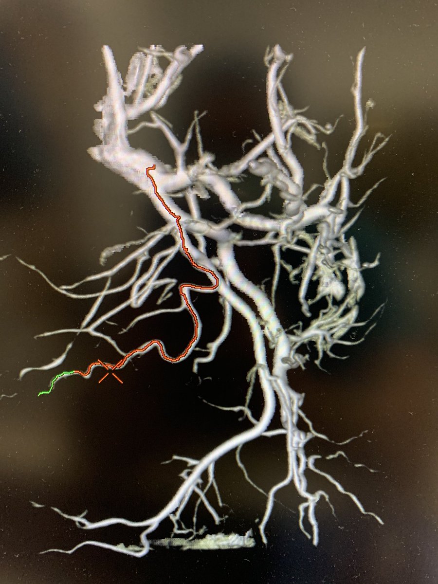 AriIsaacsonMD's tweet photo. Tortuous iliacs can make PAE tough. Use a long sheath to straighten the arteries and increase proximal support. Hard case, but total dose still only 205 mGy. @SIRRFS @StreamMeeting @IR_Nutt https://t.co/kdmEXJvBz8
