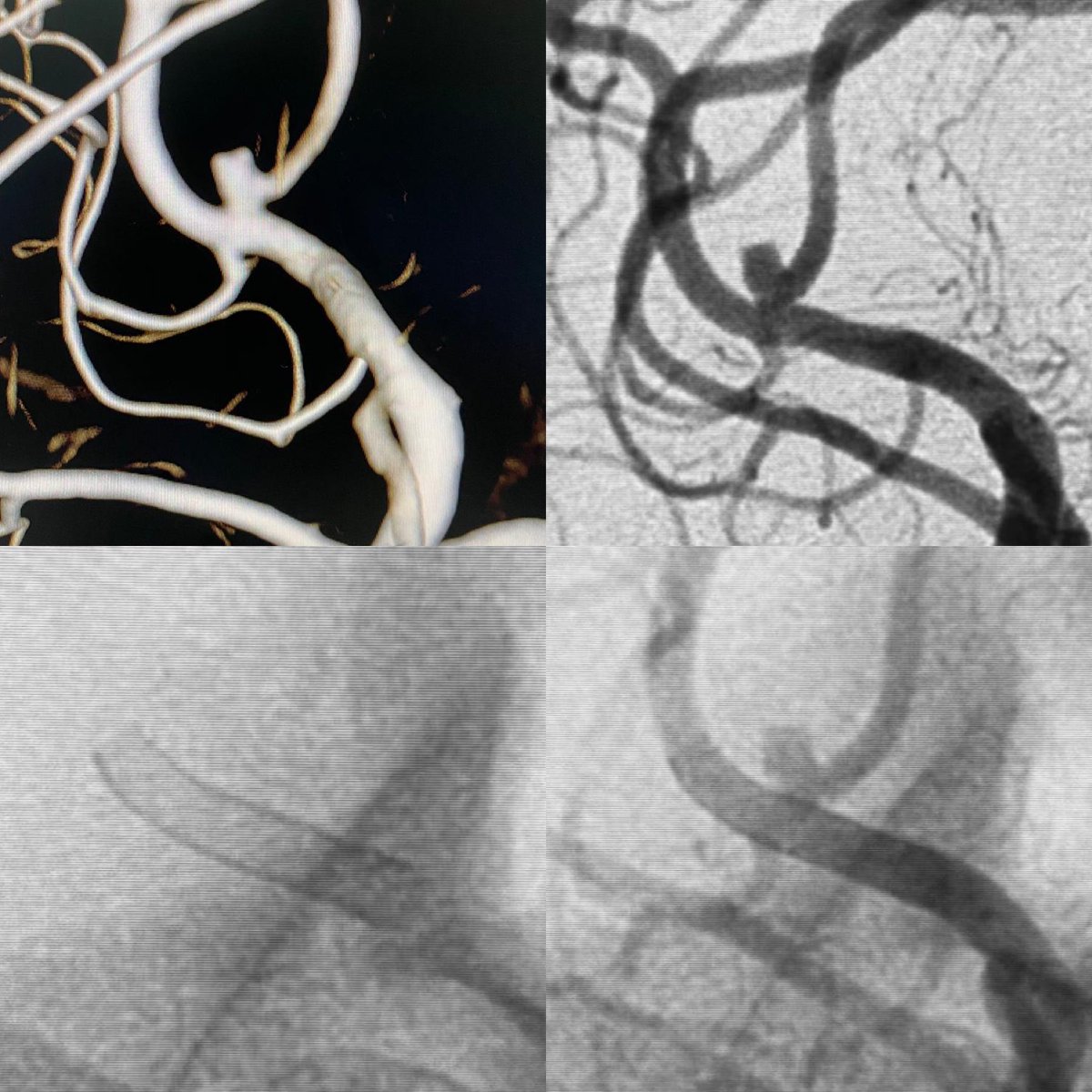 ikeafonso1's tweet photo. Right MCA aneurysm treated with the new p48 MW HPC(by @phenox_neuro) under MAPT. The future of flow diversion is now! #aneurysm @treatthestroke @esmintsociety @svinsociety @SNISinfo @SOBRICE @thebeefoundatio https://t.co/ebqugeidPk