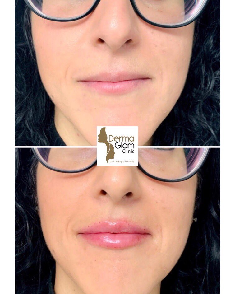 dermaglam's tweet photo. 1 ml Restylane Kysse Lip Filler for this gorgeous patient.
#torontofiller #torontolipfiller #torontolipaugmentation #torontomedicalspa https://t.co/6RzdHZvT9P