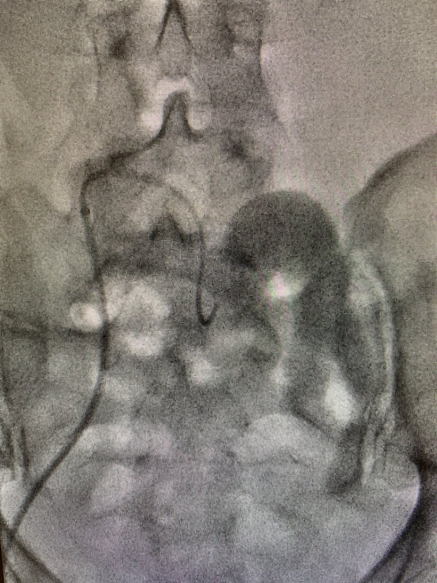 AriIsaacsonMD's tweet photo. Tortuous iliacs can make PAE tough. Use a long sheath to straighten the arteries and increase proximal support. Hard case, but total dose still only 205 mGy. @SIRRFS @StreamMeeting @IR_Nutt https://t.co/kdmEXJvBz8