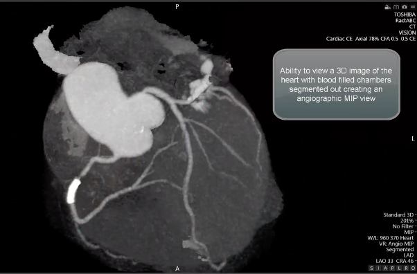 DAICeditor's tweet photo. Canon is showing its new tech at #SCCT2020. The Aquilion One Genesis SP CT offers a small foot print, one beat, whole heart acq and AI image reconstruction for lower dose. Find more at https://t.co/8ZIQ3GZqvj
#scct2020 #CCTAfirst #radiology #CVimaging #cardiotwitter https://t.co/NcFb8wzfMA