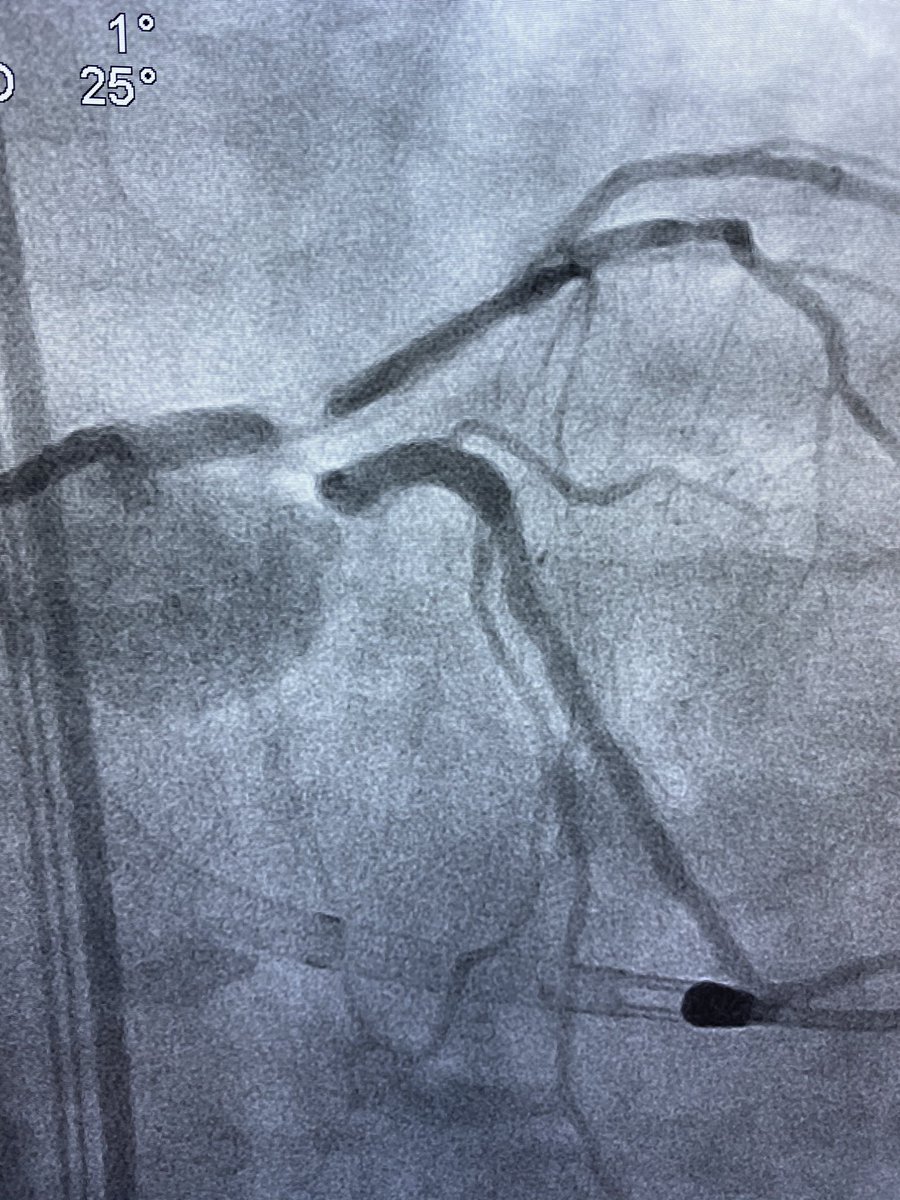 KiranCheruku2's tweet photo. 70 yr old diabetic, ESRD presents with NSTEMI. EF 35%. Turned down by CT Surgery as STS >8%mortality
Rotablation of LAD, LM, LCX PTCA of RI. DK Crush stenting 4.0 mm stents 
@SanjogKalra https://t.co/wOwYJL7F4E