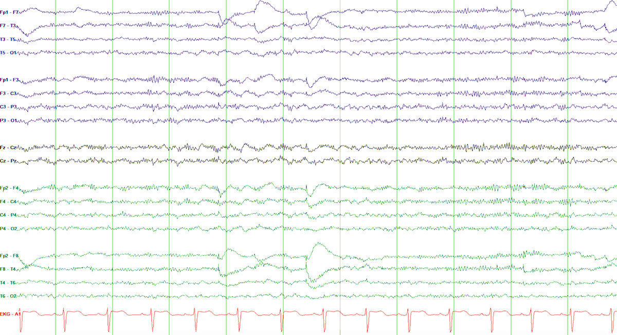 Zeke Gleichgerrcht, MD, PhD, FACNS tweet media