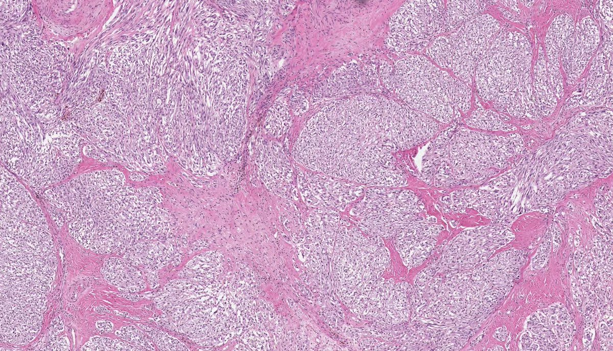 CLEAR CELL SARCOMA. NGS: EWSR1-ATF1. NB: fascicles and nests of spindle-epithelioid cells; eosinophilic-amphophilic cytoplasm; monomorphic nuclei with macronucleoli and rare mitotic activity; thin fibrous septa, wreath-like multinucleated giant cells and melanin pigment.