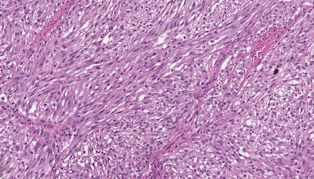 CLEAR CELL SARCOMA. NGS: EWSR1-ATF1. NB: fascicles and nests of spindle-epithelioid cells; eosinophilic-amphophilic cytoplasm; monomorphic nuclei with macronucleoli and rare mitotic activity; thin fibrous septa, wreath-like multinucleated giant cells and melanin pigment.