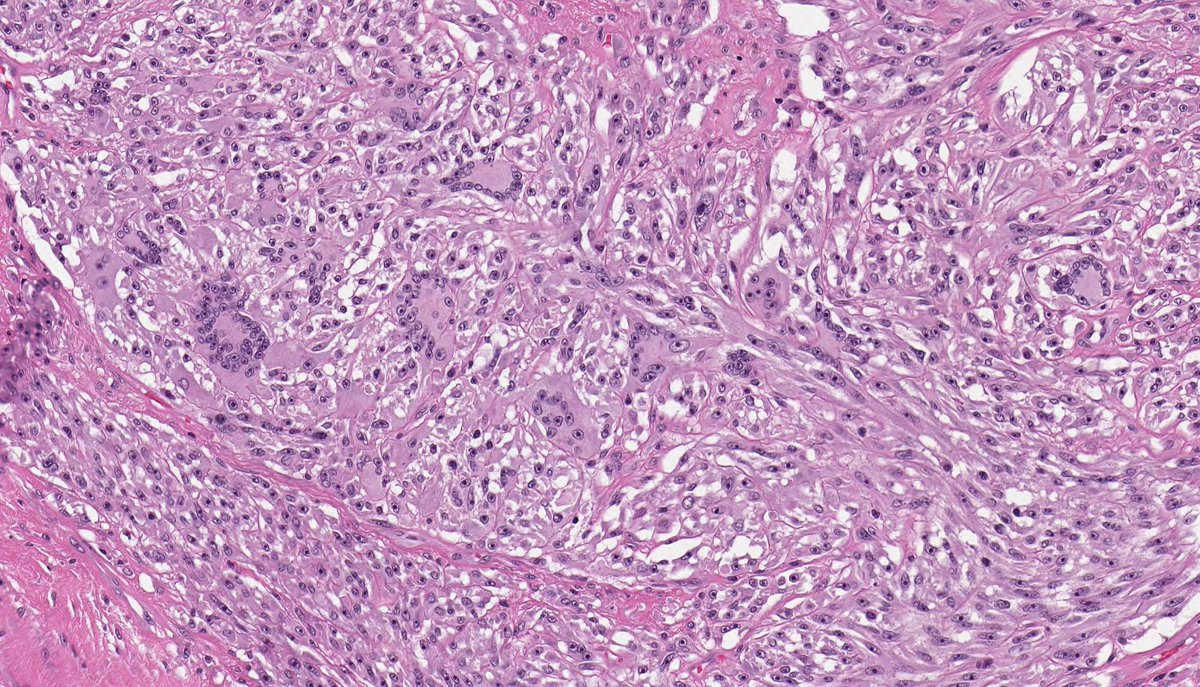 CLEAR CELL SARCOMA. NGS: EWSR1-ATF1. NB: fascicles and nests of spindle-epithelioid cells; eosinophilic-amphophilic cytoplasm; monomorphic nuclei with macronucleoli and rare mitotic activity; thin fibrous septa, wreath-like multinucleated giant cells and melanin pigment.