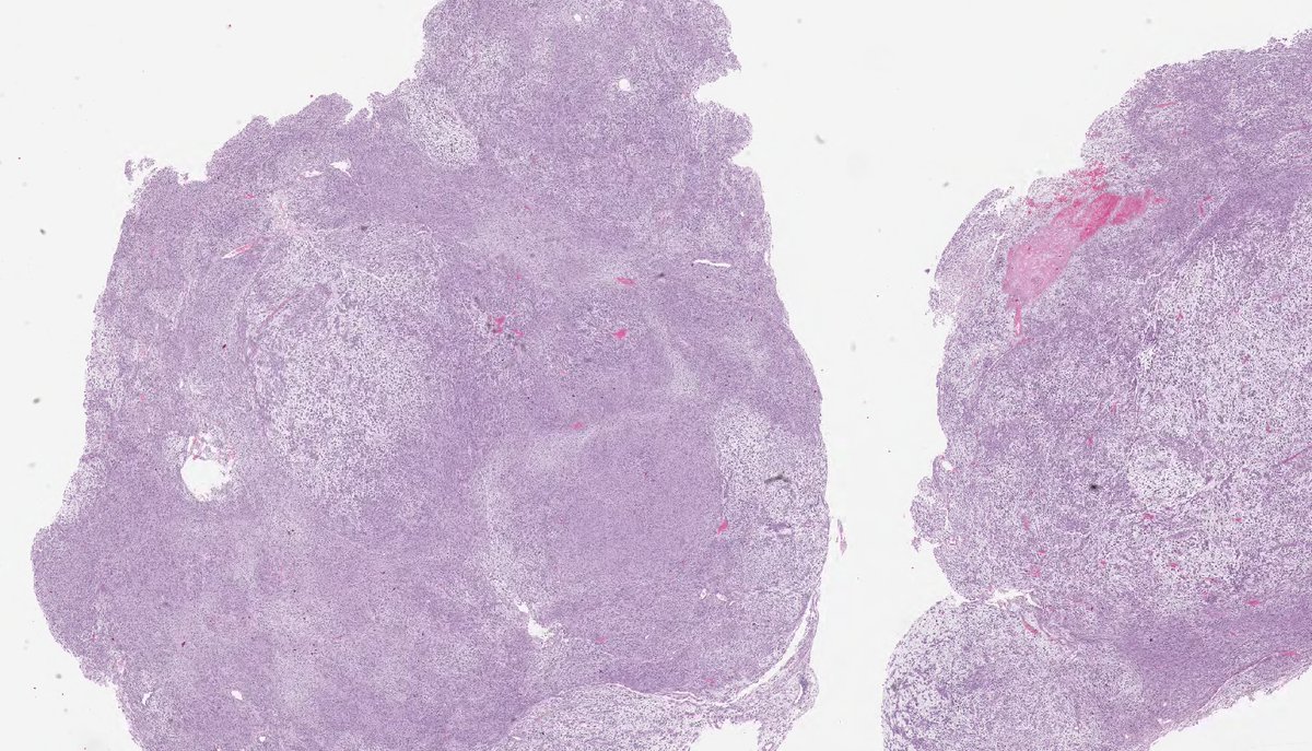 MYXOFIBROSARCOMA (epithelioid variant). NB: cellular fascicles of spindle cells & small cohesive clusters of epithelioid cells in abundant myxoid stroma; abundant eosinophilic cytoplasm; ovoid-round nuclei, with pleomorphism and conspicuous mitotic activity. (PMID: 17197925).