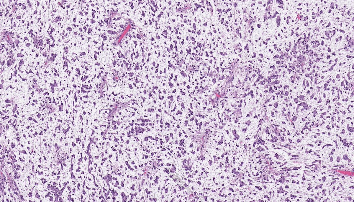 MYXOFIBROSARCOMA (epithelioid variant). NB: cellular fascicles of spindle cells & small cohesive clusters of epithelioid cells in abundant myxoid stroma; abundant eosinophilic cytoplasm; ovoid-round nuclei, with pleomorphism and conspicuous mitotic activity. (PMID: 17197925).