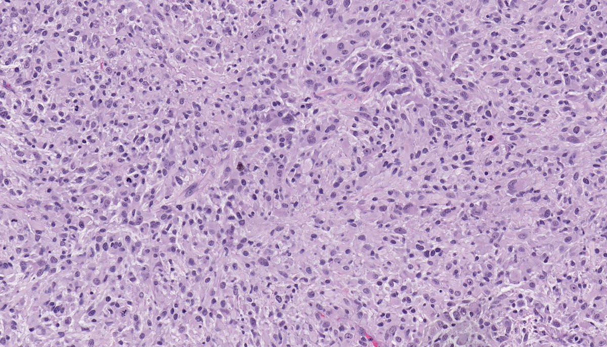 MYXOFIBROSARCOMA (epithelioid variant). NB: cellular fascicles of spindle cells & small cohesive clusters of epithelioid cells in abundant myxoid stroma; abundant eosinophilic cytoplasm; ovoid-round nuclei, with pleomorphism and conspicuous mitotic activity. (PMID: 17197925).