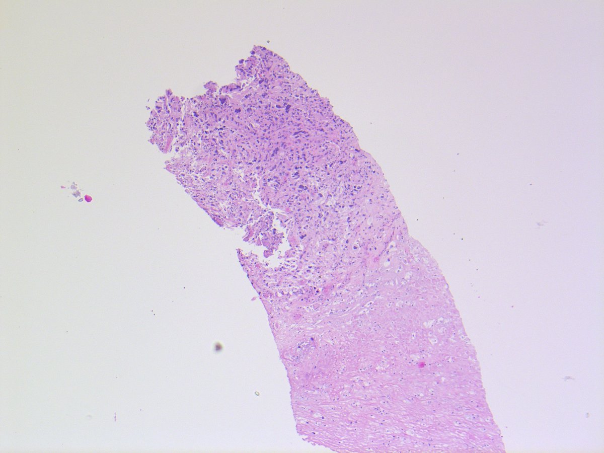 UNDIFFERENTIATED PLEOMORPHIC SARCOMA. NB: no identifiable line of differentiation by IHC; sheets of polygonal-epithelioid cells; abundant eosinophilic cytoplasm; marked nuclear pleomorphism, with multinucleation and conspicuous mitotic activity; necrosis.