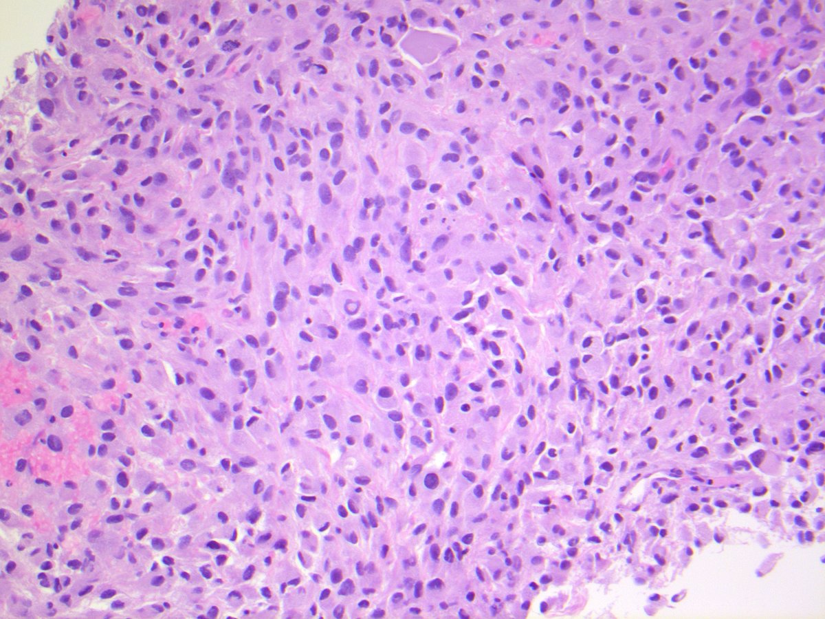 UNDIFFERENTIATED PLEOMORPHIC SARCOMA. NB: no identifiable line of differentiation by IHC; sheets of polygonal-epithelioid cells; abundant eosinophilic cytoplasm; marked nuclear pleomorphism, with multinucleation and conspicuous mitotic activity; necrosis.