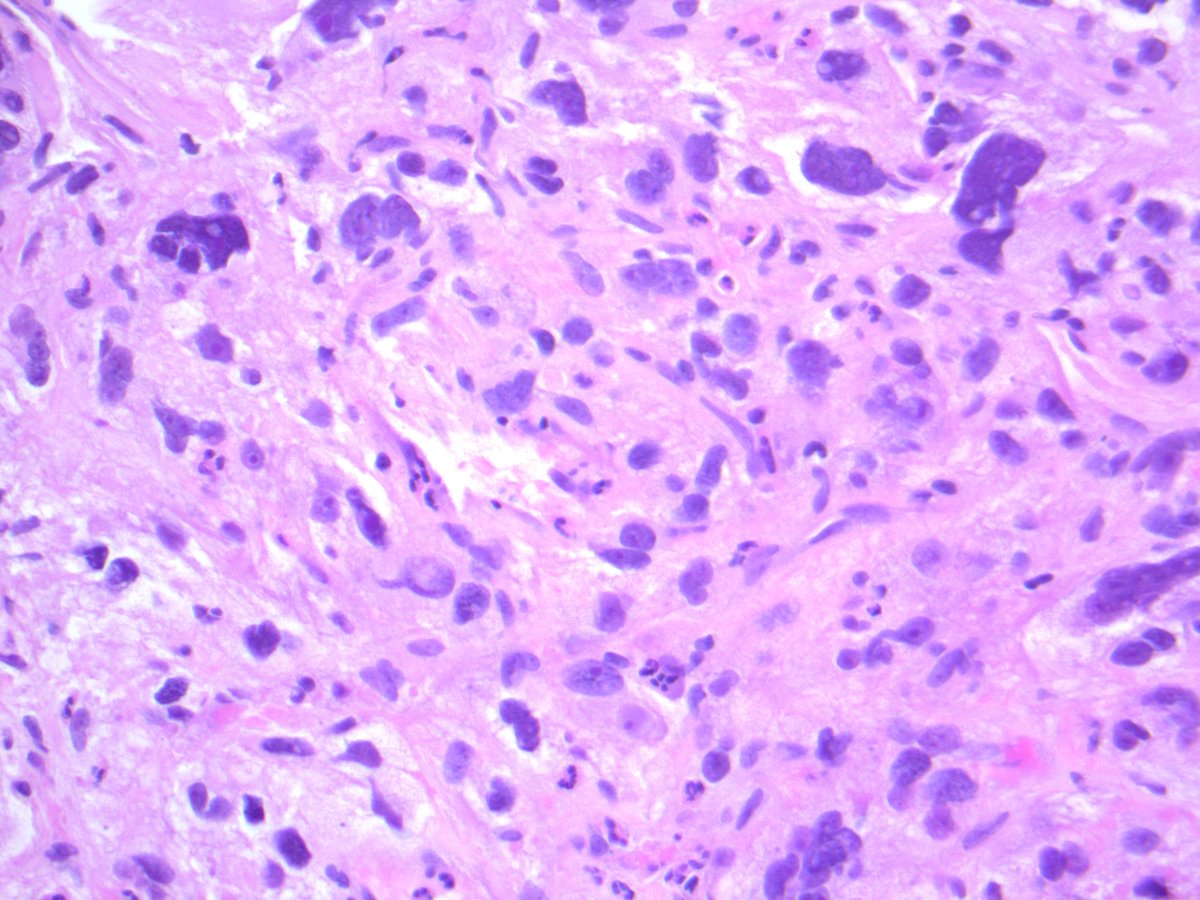 UNDIFFERENTIATED PLEOMORPHIC SARCOMA. NB: no identifiable line of differentiation by IHC; sheets of polygonal-epithelioid cells; abundant eosinophilic cytoplasm; marked nuclear pleomorphism, with multinucleation and conspicuous mitotic activity; necrosis.