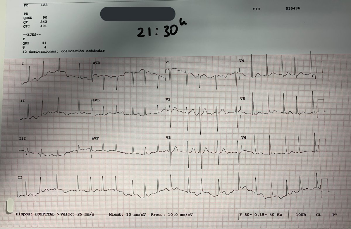 sergiosng_'s tweet photo. Hoy he hecho un ECG a un paciente porque me parecía que tenía pulso irregular... Sin antecedentes de base.
A veces los enfermeros también servimos para algo más que sacar analíticas y dar medicación😉
#ECG #EKG https://t.co/P5dU7LlTaG