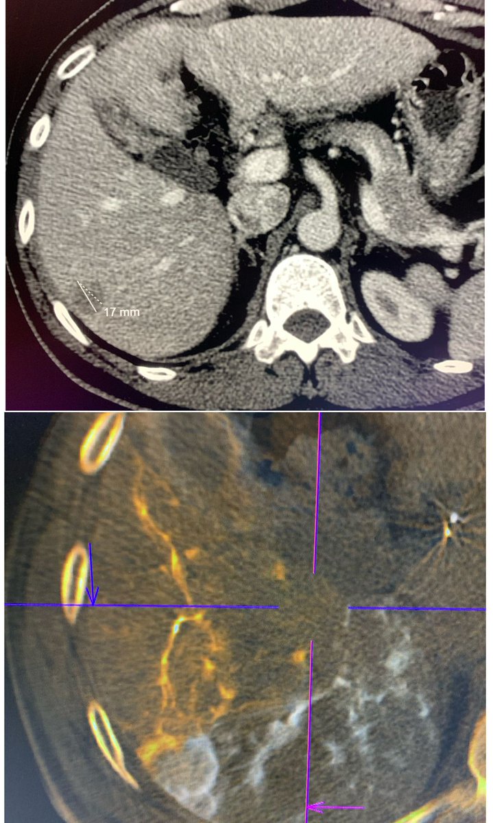AustinBourgeois's tweet photo. Y90 mapping for #radseg.  Bottom image shows conebeam CT fusion of both branches supplying the small HCC.  Important to realize minor perfusion to the mass to achieve a CR.  #keeplooking #iRad #IRonc #livertwitter https://t.co/gfmx1k7QQz