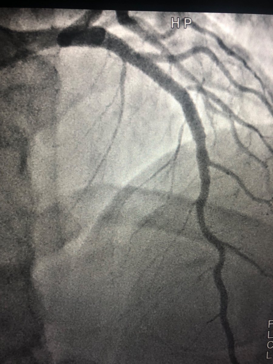 DrQuinnCapers4's tweet photo. These results brought to you courtesy of our new Interventional Fellow, Dr Moses Ashukem (L) and General fellow @KellyPaschkeDO (R). Acute Coronary Syndromes don’t stand a chance when we build diverse teams in the cath lab! 

#TakeAWomanToTheCathLab 
#BlackMenInMedicine https://t.co/1VISl6ukTJ