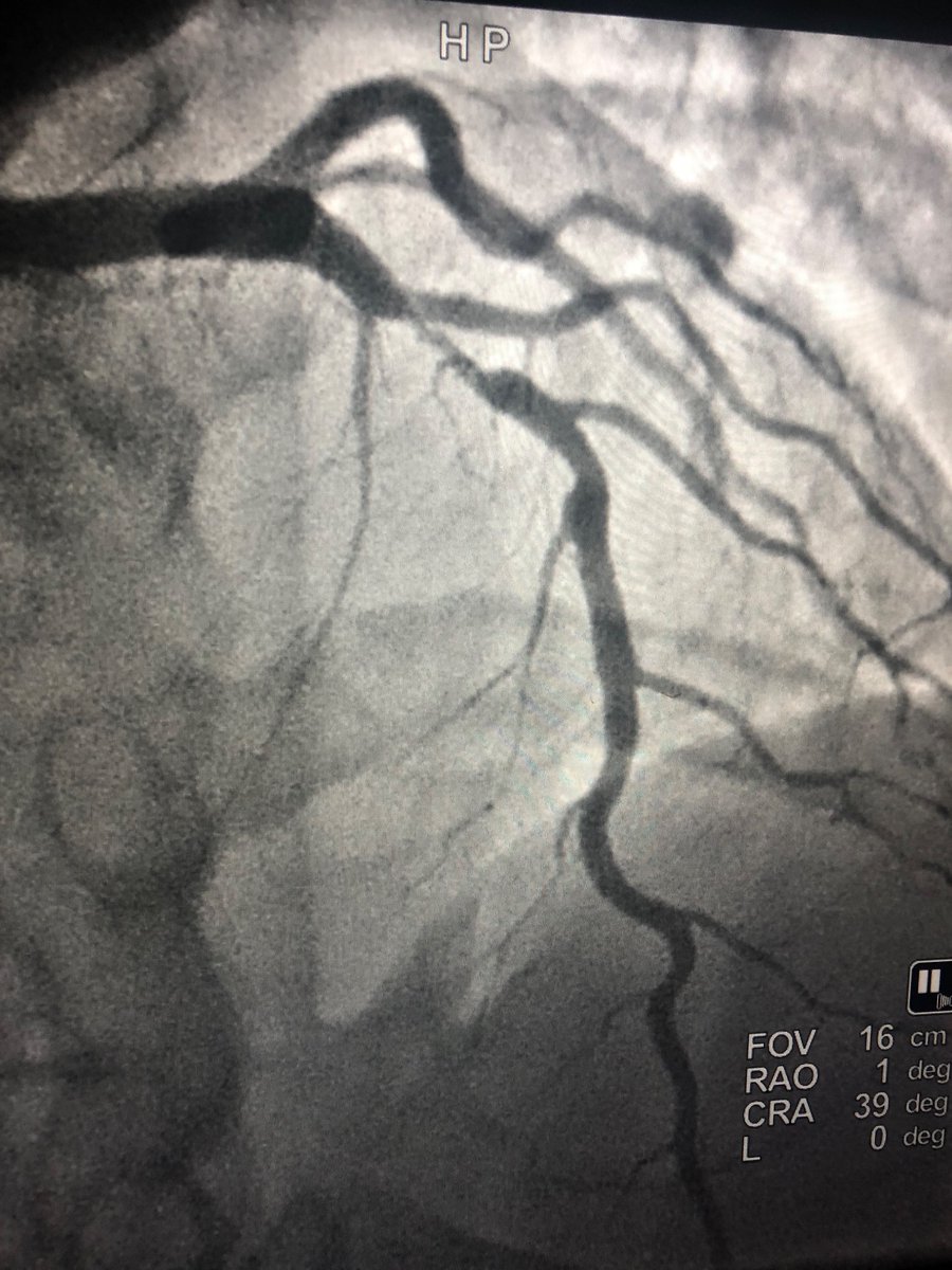 DrQuinnCapers4's tweet photo. These results brought to you courtesy of our new Interventional Fellow, Dr Moses Ashukem (L) and General fellow @KellyPaschkeDO (R). Acute Coronary Syndromes don’t stand a chance when we build diverse teams in the cath lab! 

#TakeAWomanToTheCathLab 
#BlackMenInMedicine https://t.co/1VISl6ukTJ