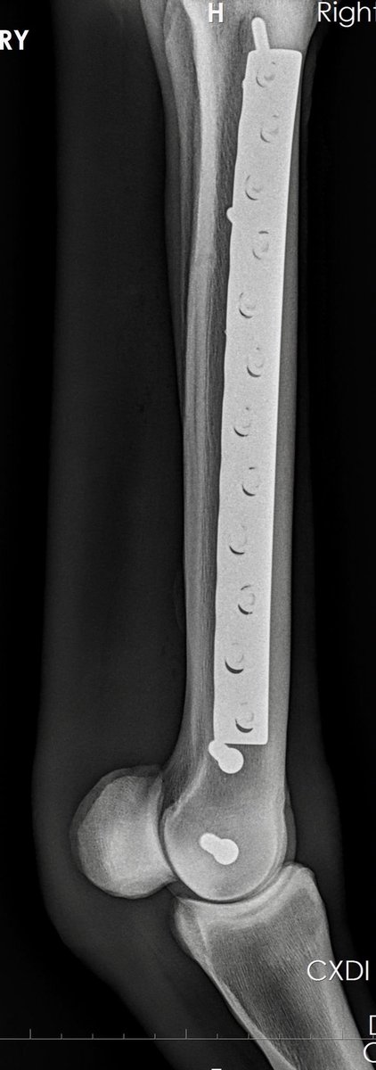 HoganEquine's tweet photo. Phew👩🏼⚕️busy day at the office! This TB from @NYRA shipped in for repair of a serious spiral condylar fracture.The plate and screws compress the fx and safeguard against catastrophe. All will be removed at 60 days and racing prognosis is actually excellent🙌🏻#basiccarpentry 🐎 https://t.co/KtRkC40Ah8
