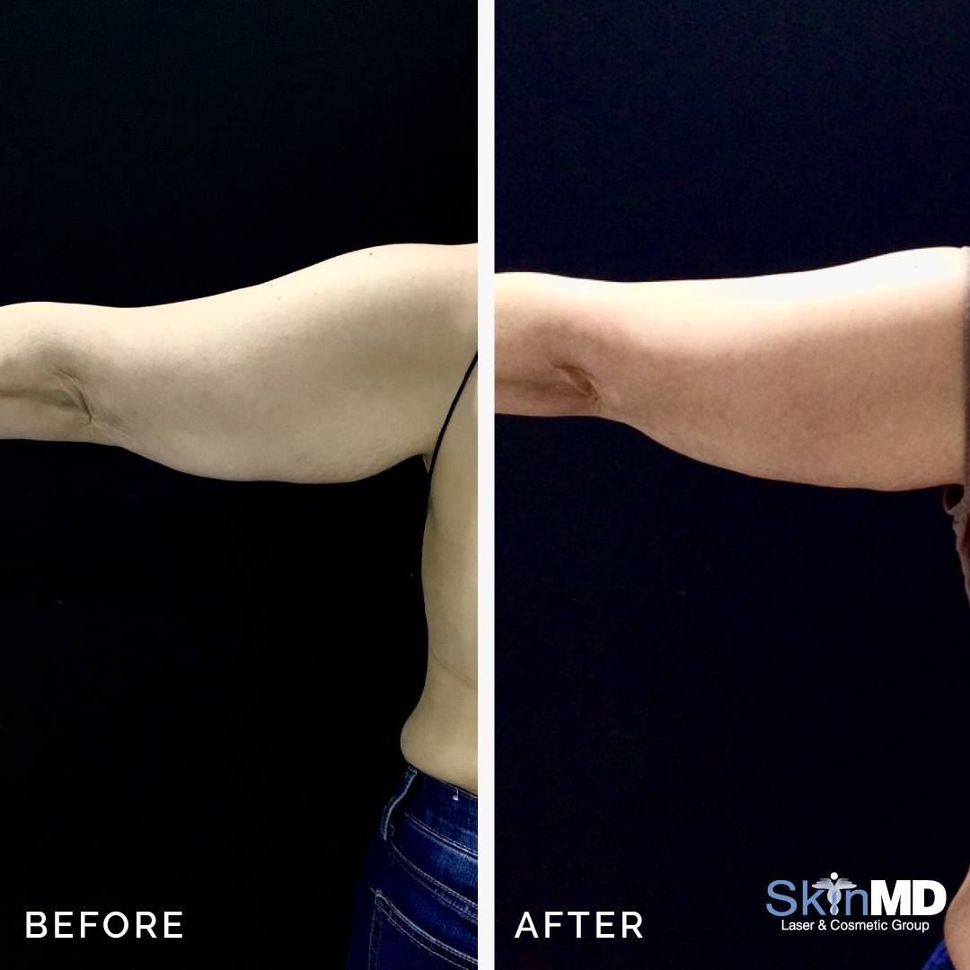 skinmdBOS's tweet photo. Amazing CoolSculpting before and after for arms with 4 Venus treatments! 💪 
Get your arms COOL for the Summer! ☀️

Schedule your free consultation with us today: https://t.co/x2KubYStlN 
#CoolSculpting #skincare #skinmd #beforeandafter #tonedarms https://t.co/evUdQY4aeI