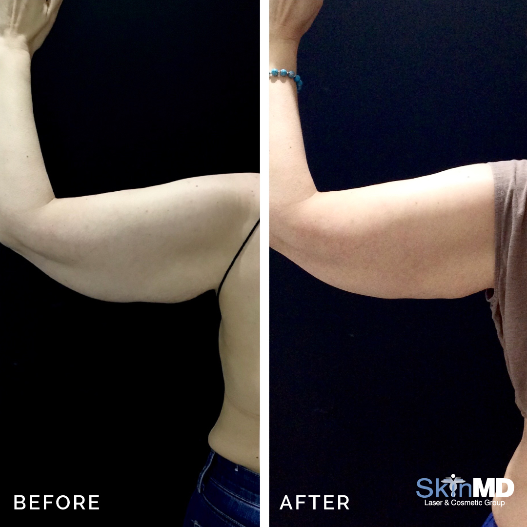 skinmdBOS's tweet photo. Amazing CoolSculpting before and after for arms with 4 Venus treatments! 💪 
Get your arms COOL for the Summer! ☀️

Schedule your free consultation with us today: https://t.co/x2KubYStlN 
#CoolSculpting #skincare #skinmd #beforeandafter #tonedarms https://t.co/evUdQY4aeI
