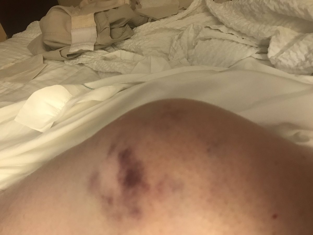 bail4u2's tweet photo. All from falling https://t.co/HomfOiFJNv