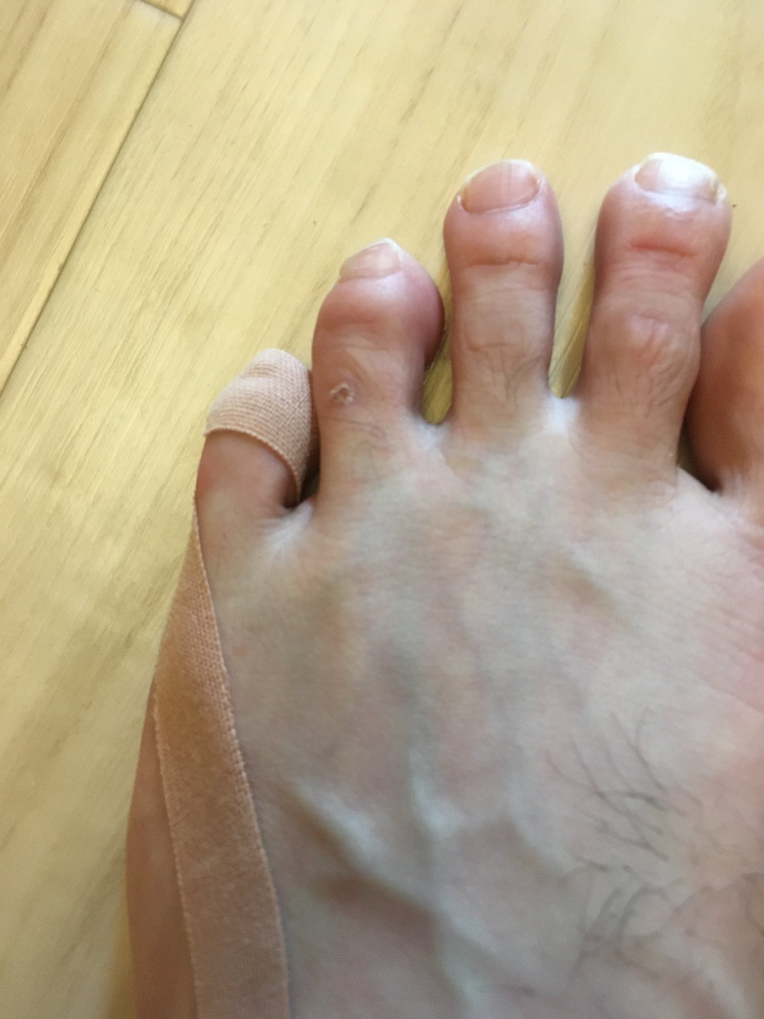 糸屯 アロハ パーティー 寝指を直そうと一週間ほど前からテーピングを続けています 小指の爪周りの激しい角質化と痛みがマシになったような気がします 他良い方法あれば教えてくださーい 寝指 内外小指 T Co 46zgvstw7p Twitter
