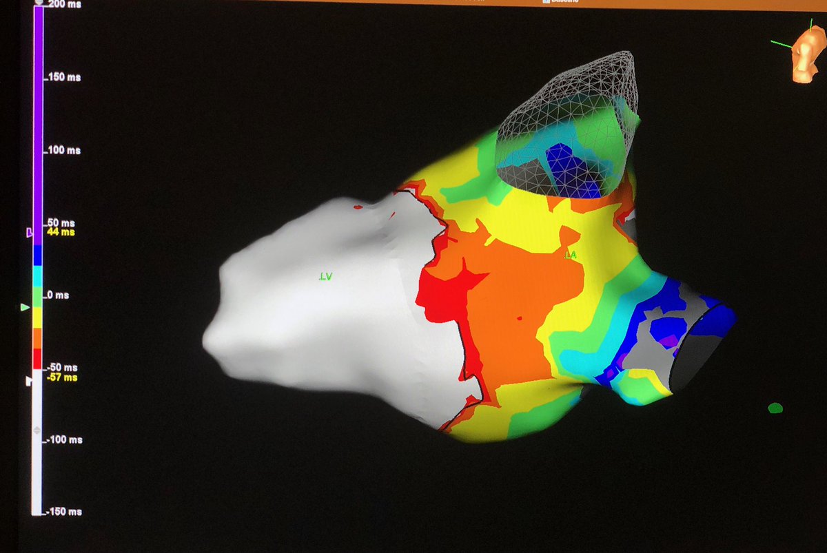 GVenkataramanEP's tweet photo. First time using open window technique for mapping left sided pathways!    Two cases this week.   First case in ORT and second case with atrial pacing / maximal pre-excitation.   #hdgrid  #epeeps @AbbottCardio Nice mapping, @Benj67907044 https://t.co/kxF38lk2da