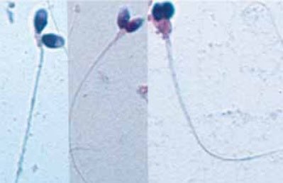 semen analysis pada pria 28th.
dia perokok sejak usai 15th,  hasilnya teratozoospermia (sperma berbentuk tdk normal).
Dia tdk percaya krn ayah nya juga perokok tp bisa punya anak 5 org.
Pas lihat ini dia baru percaya.