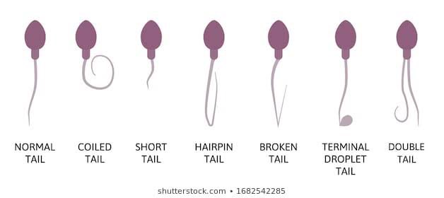 miemie19Falinda's tweet photo. semen analysis pada pria 28th.
dia perokok sejak usai 15th,  hasilnya teratozoospermia (sperma berbentuk tdk normal).
Dia tdk percaya krn ayah nya juga perokok tp bisa punya anak 5 org.
Pas lihat ini dia baru percaya. https://t.co/tP5v8QWKEi