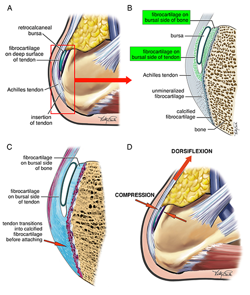EarleArt's tweet photo. Fun series to create - critical role of compression in retrocalcaneal bursitis. Drawn to show partnership of tendon, bursa and bone at the Achilles insertion point. Done for @PeterBrukner Brukner &amp; @KarimKhan_IMHA  Clinical Sports Medicine. @GNSIorg #sciartportfolioweek @Sci_Art https://t.co/JT81f2wH3T